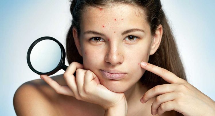 Acne – How To Treat Acne