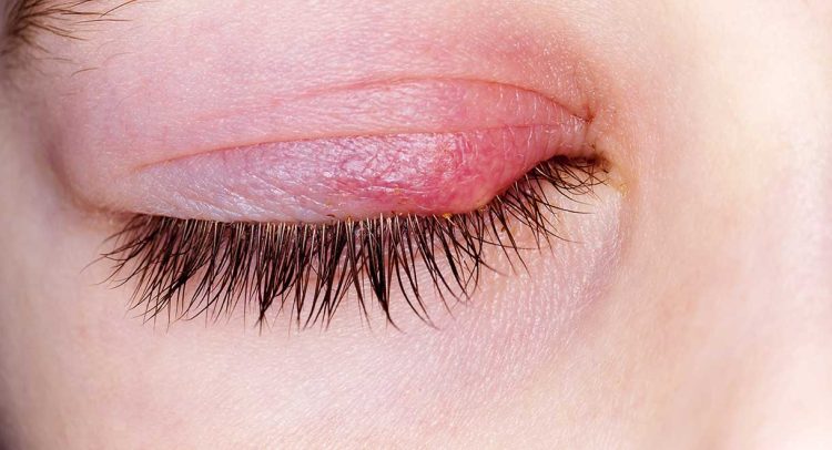 Blepharitis