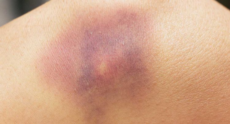 Bruising
