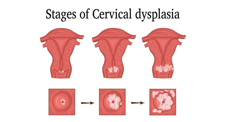 Cervical Dysplasia