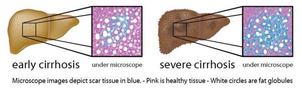 Liver-Doctor-Liver-Cirrhosis