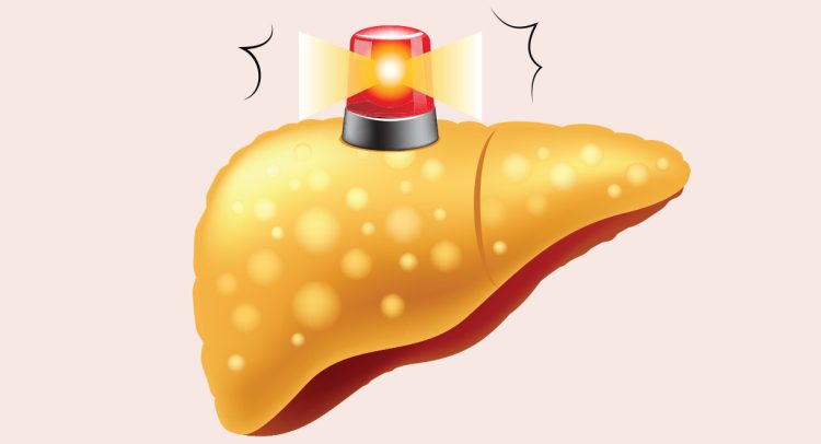 Fatty Liver and Epstein Barr Case Study