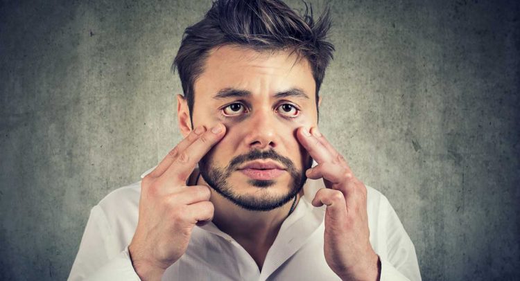 Do You Have Dark Circles Under Your Eyes?