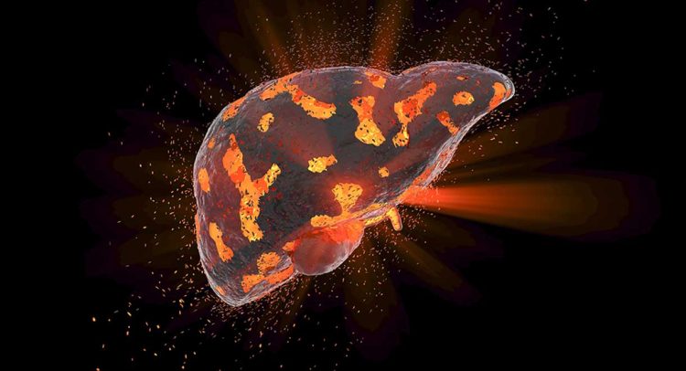 Are Toxins Accumulating In Your Liver?
