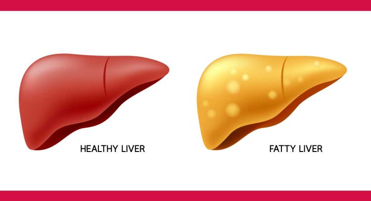 Fatty Liver