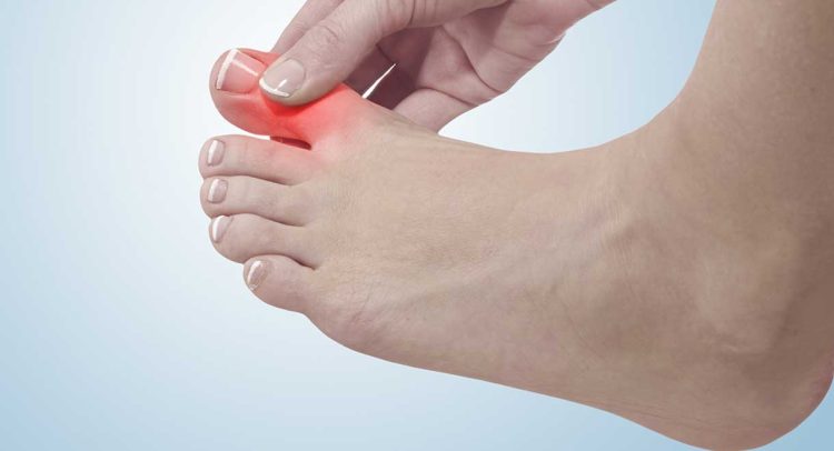 Gout