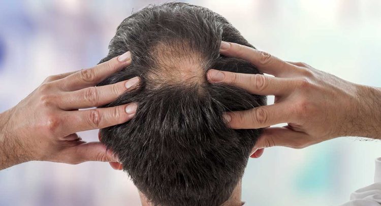 Hair Loss