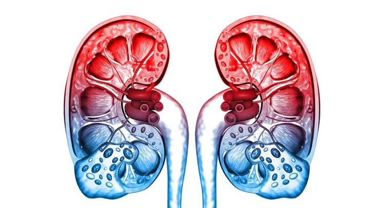 Kidney Stones
