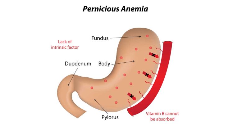Pernicious Anemia