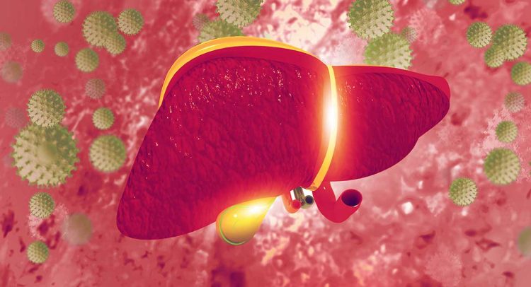 Primary Biliary Cholangitis (PBC)