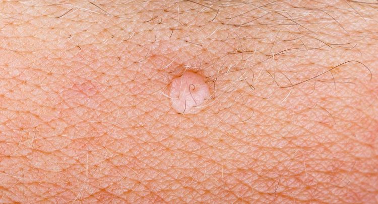 Warts