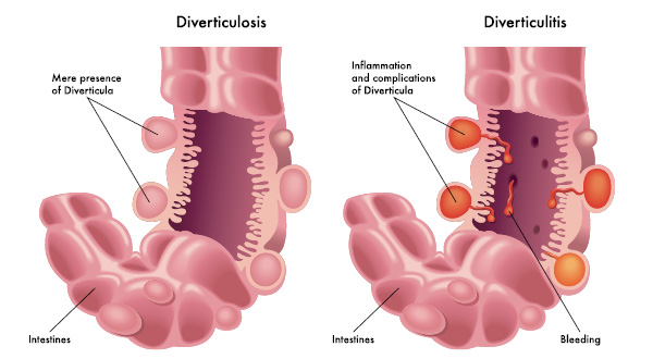 Diverticular Disease