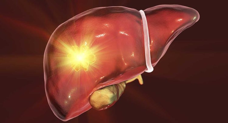 Adenomas Of The Liver