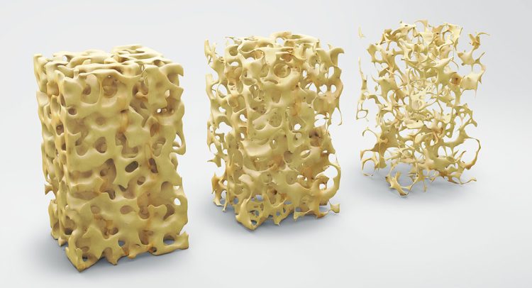 Osteoporosis: Best Remedies For Prevention And Management