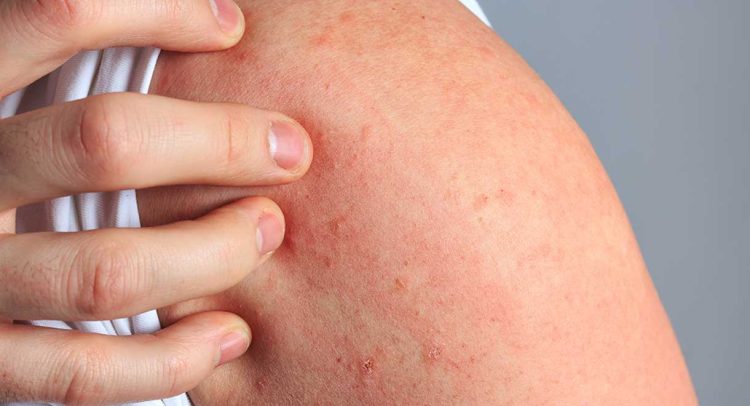 Urticaria (Hives)