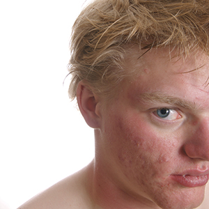 Acne and Eczema