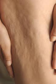 What is cellulite and can anything be done about it?