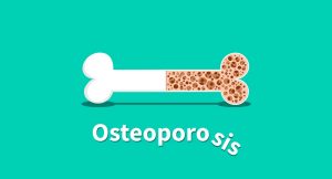 Osteoporosis – what you must know