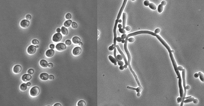 Are you suffering with Candida overgrowth?