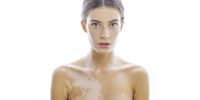 Vitamin D helps to treat vitiligo