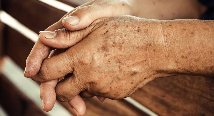 What To Do About Liver Spots (Age Spots)