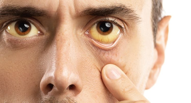 Gilbert’s Syndrome Is Common. You May Not Know You Have It