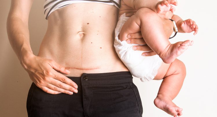 Vitamin D Deficiency Linked To C-Section Delivery