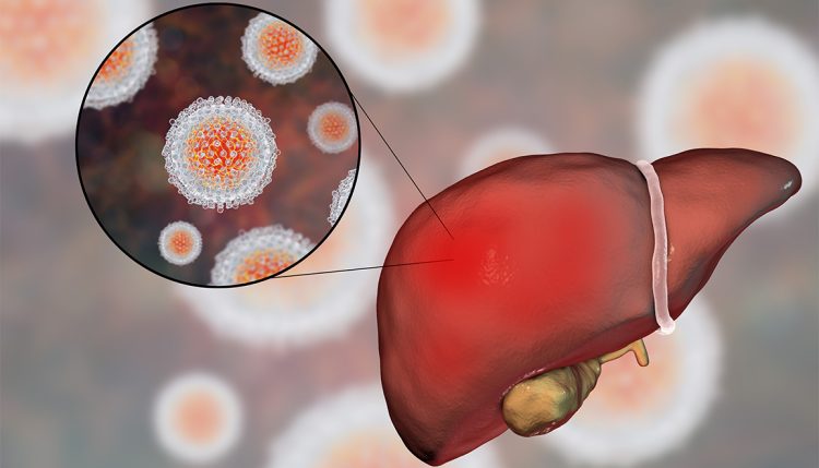 Hepatitis C – A Nasty Liver Virus