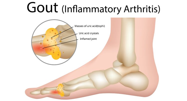 Why Is Gout Becoming So Prevalent?