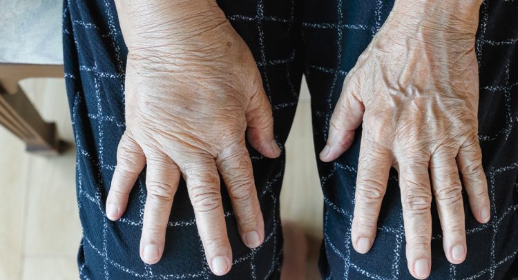 Natural Remedies To Beat Fluid Retention