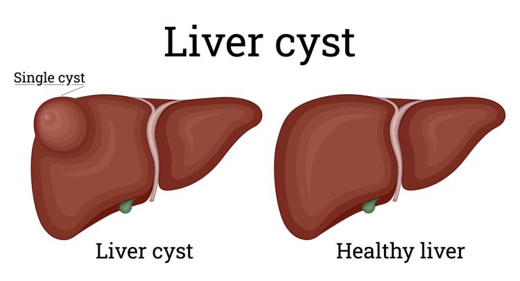 Vital Information About Liver Cysts