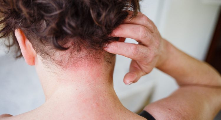 Case Study: Underactive Thyroid And Psoriasis