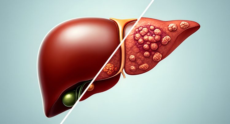 Help Your Liver To Restore Your Health