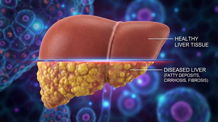 Natural Remedies To Help Cirrhosis