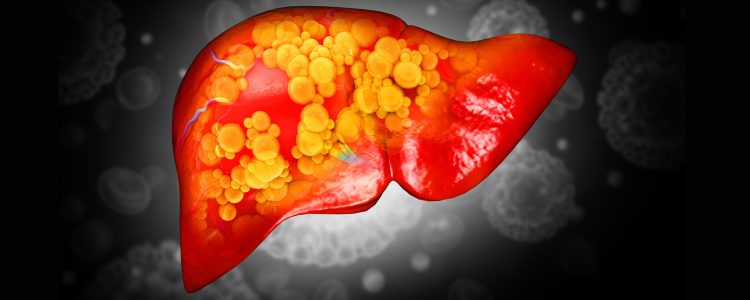 The Liver Problem Linked to PCOS